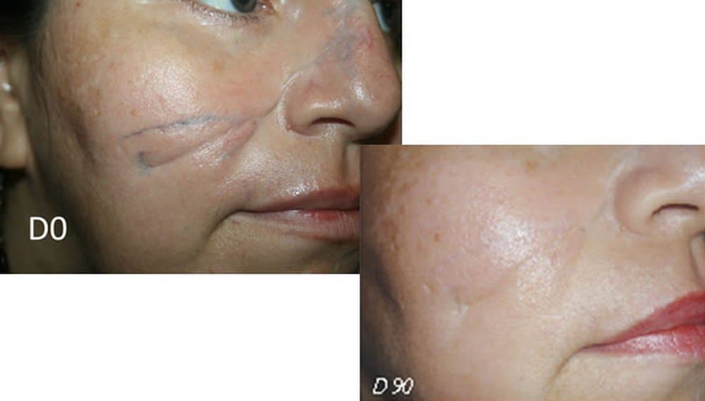 for Treatment of Scars - 30g - Psoriasis Eczema Scars