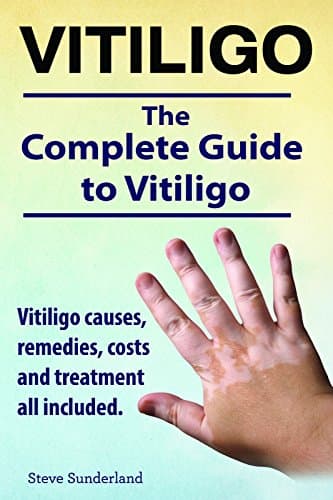 Vitiligo. Vitiligo causes, remedies, costs and treatment all included. The complete Vitiligo Book.