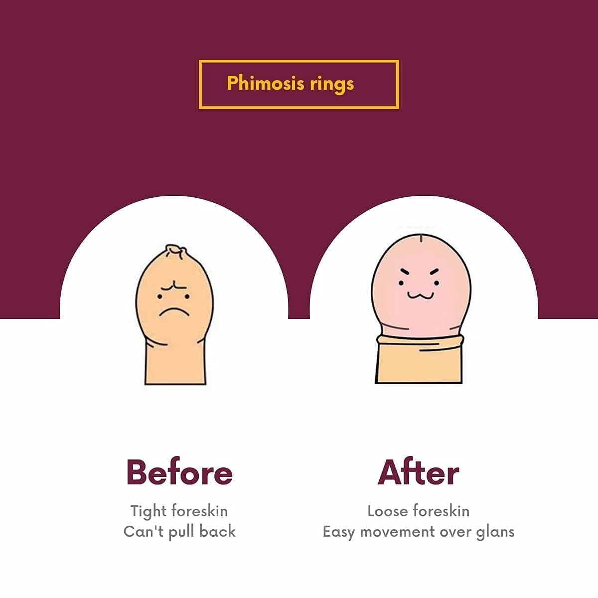 Vajraang Phimosis Stretching Rings (20 Rings Set) with Applicator Tool and 'How to use' Booklet