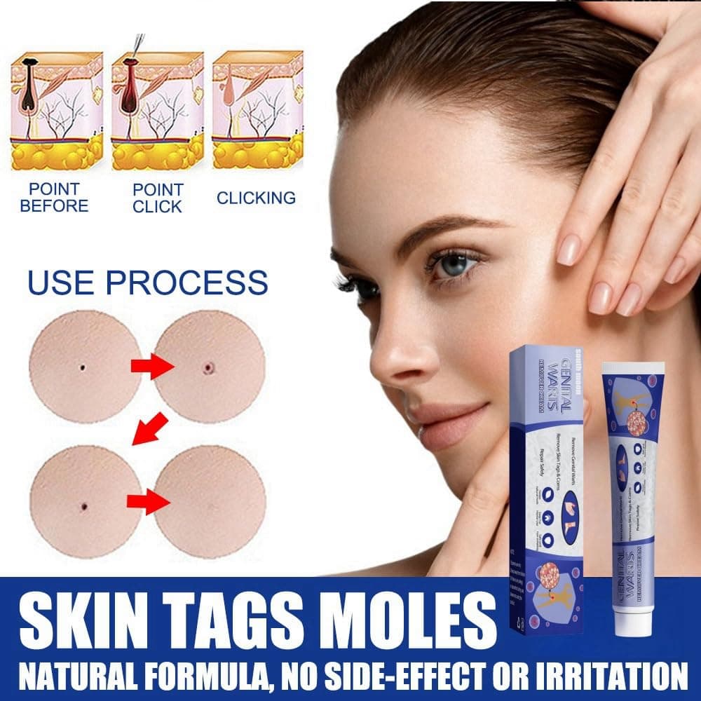 Skin Tag Remover Cream,Skin Wart Remover for Skin and Face,Skin Wart Treatment,Tags and Mole Remover Cream for Body,Natural Wart Remover Cream for Hands and Foot,Fast-Acting Tag Remover Skin1
