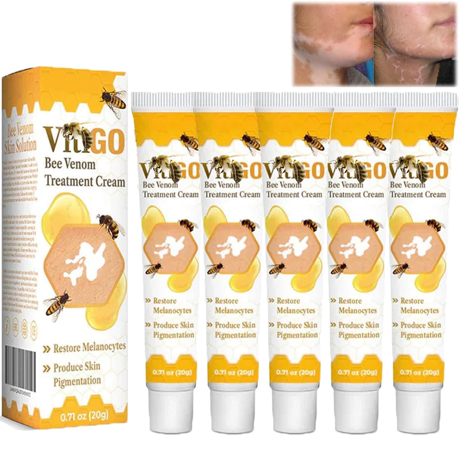 Vitiligo Bee Venom Treatment Cream (5pcs)